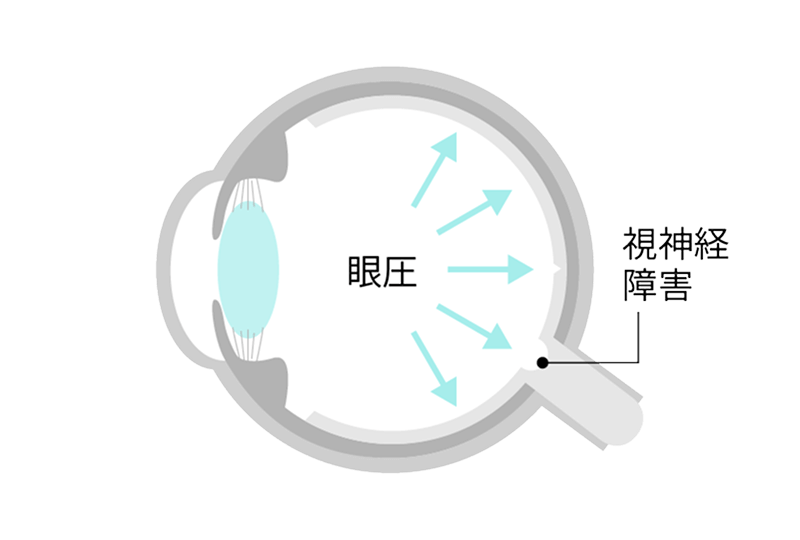 濁った水晶体では網膜にきれいな像が映らない