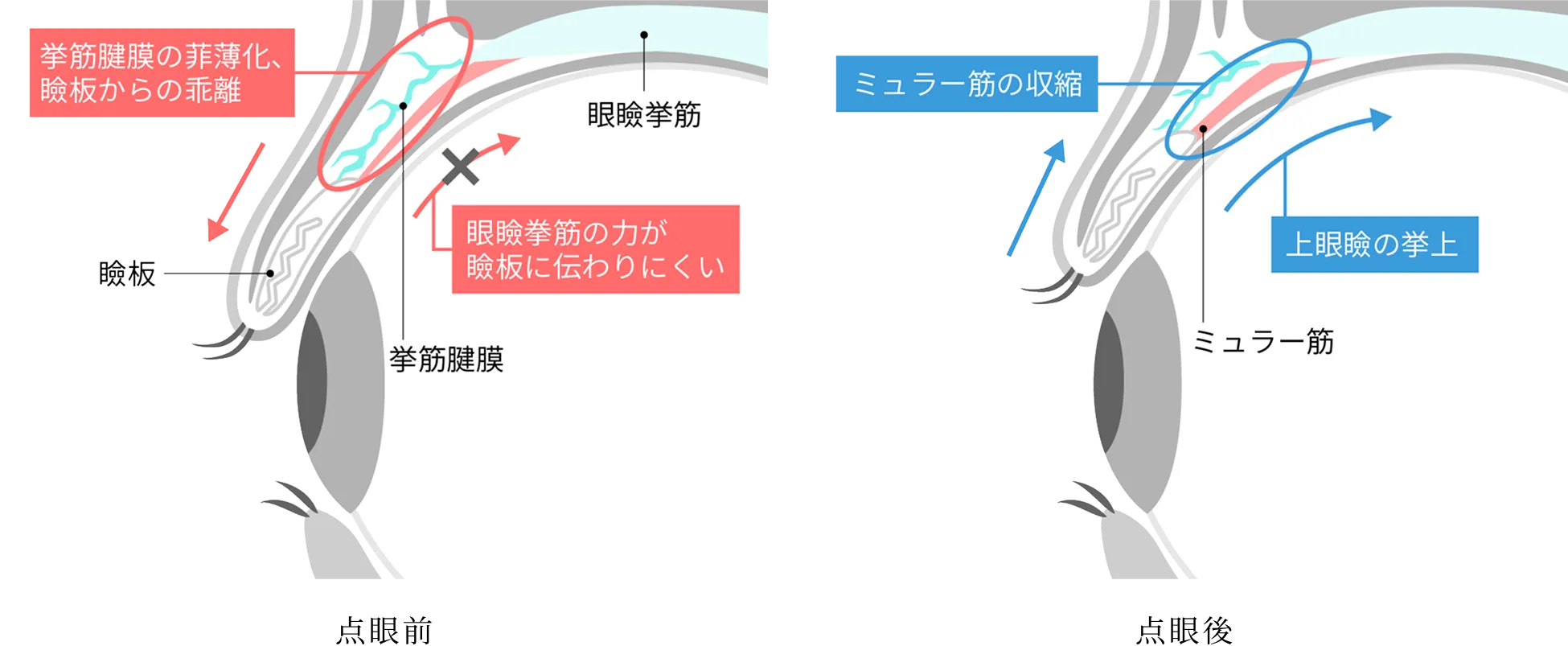 点眼前と点眼後を比較したイラスト。